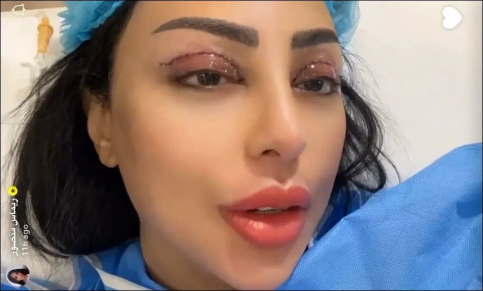 بالفيديو .. فنانة سعودية تثير الجدل بعد عملية «قص الجفون» وتصرّح: ”صرت مزّة المزّات”