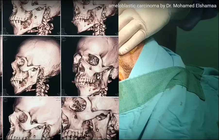 عملية جراحية لإزالة سرطان الفم