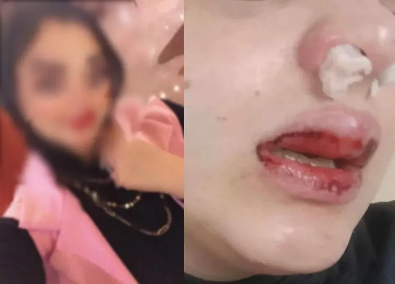 اعتداء زوج على طليقته في بور سعيد.. لخلاف على طفلتهما شوّه وجهها... اعتداء زوج على طليقته في بور سعيد.. لخلاف على طفلتهما شوّه وجهها وكسر أسنانها